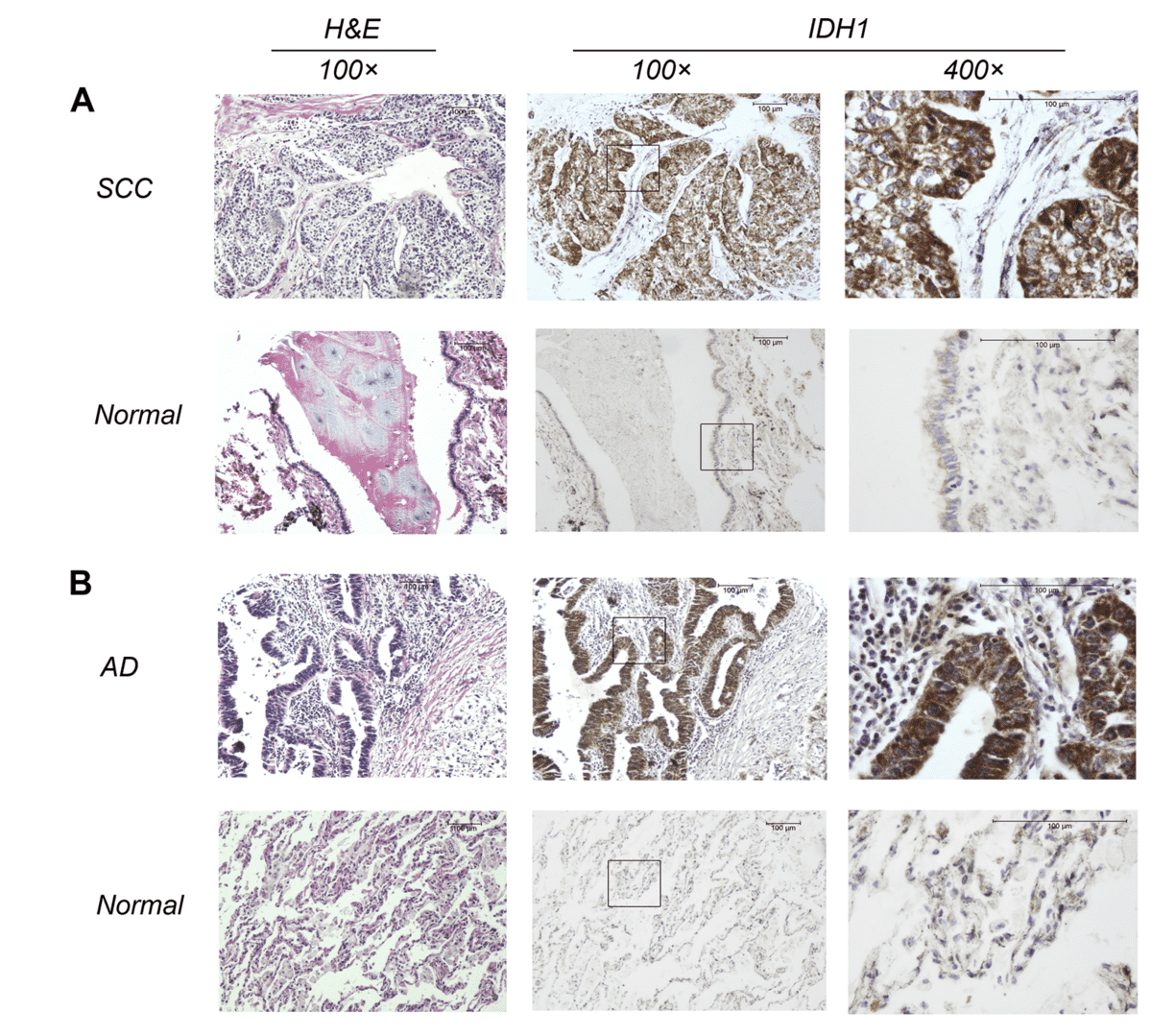 Immunohistochemical staining against IDH1 in tumors of both squamous cell carcinoma.